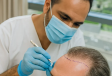 Is a Hair Transplant in Dubai Your Path to Fuller Hair?