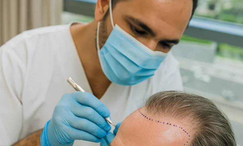 Is a Hair Transplant in Dubai Your Path to Fuller Hair?
